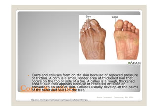 Corns and calluses form on the skin because of repeated pressure
   or friction. A corn is a small, tender area of thickened skin that
   occurs on the top or side of a toe. A callus is a rough, thickened
   area of skin that appears because of repeated irritation or
Corns & callues
   pressure to an area of skin. Calluses usually develop on the palms
   of the hand and soles of the feet.

                                                                           Maria Carmela L. Domocmat, RN, MSN
  http://www.nlm.nih.gov/medlineplus/ency/images/ency/fullsize/19657.jpg
 
