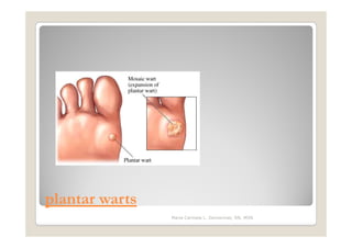 plantar warts
                Maria Carmela L. Domocmat, RN, MSN
 