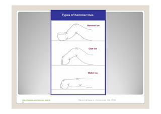 http://feetdoc.com/hammer_toes.ht   Maria Carmela L. Domocmat, RN, MSN
m
 