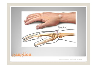 ganglion
           Maria Carmela L. Domocmat, RN, MSN
 