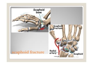 scaphoid fracture
                    Maria Carmela L. Domocmat, RN, MSN
 