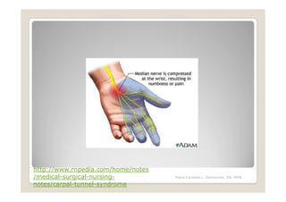 http://www.rnpedia.com/home/notes
/medical-surgical-nursing-          Maria Carmela L. Domocmat, RN, MSN

notes/carpal-tunnel-syndrome
 