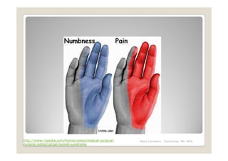 http://www.rnpedia.com/home/notes/medical-surgical-   Maria Carmela L. Domocmat, RN, MSN
nursing-notes/carpal-tunnel-syndrome
 
