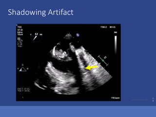 ©2017 Trinity Health Of New England
1
4
Shadowing Artifact
 