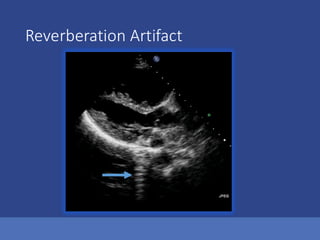 Reverberation Artifact
 
