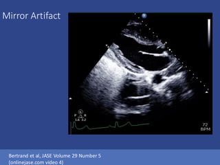 Mirror Artifact
Bertrand et al, JASE Volume 29 Number 5
(onlinejase.com video 4)
 
