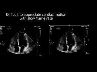 Difficult to appreciate cardiac motion
with slow frame rate
 