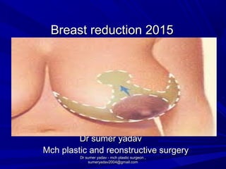 Breast reduction 2015Breast reduction 2015
Dr sumer yadavDr sumer yadav
Mch plastic and reonstructive surgeryMch plastic and reonstructive surgery
Dr sumer yadav - mch plastic surgeon ,Dr sumer yadav - mch plastic surgeon ,
sumeryadav2004@gmail.comsumeryadav2004@gmail.com
 