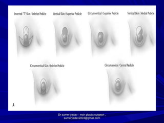 Dr sumer yadav - mch plastic surgeon ,Dr sumer yadav - mch plastic surgeon ,
sumeryadav2004@gmail.comsumeryadav2004@gmail.com
 