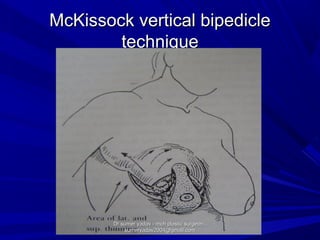 McKissock vertical bipedicleMcKissock vertical bipedicle
techniquetechnique
Dr sumer yadav - mch plastic surgeon ,Dr sumer yadav - mch plastic surgeon ,
sumeryadav2004@gmail.comsumeryadav2004@gmail.com
 
