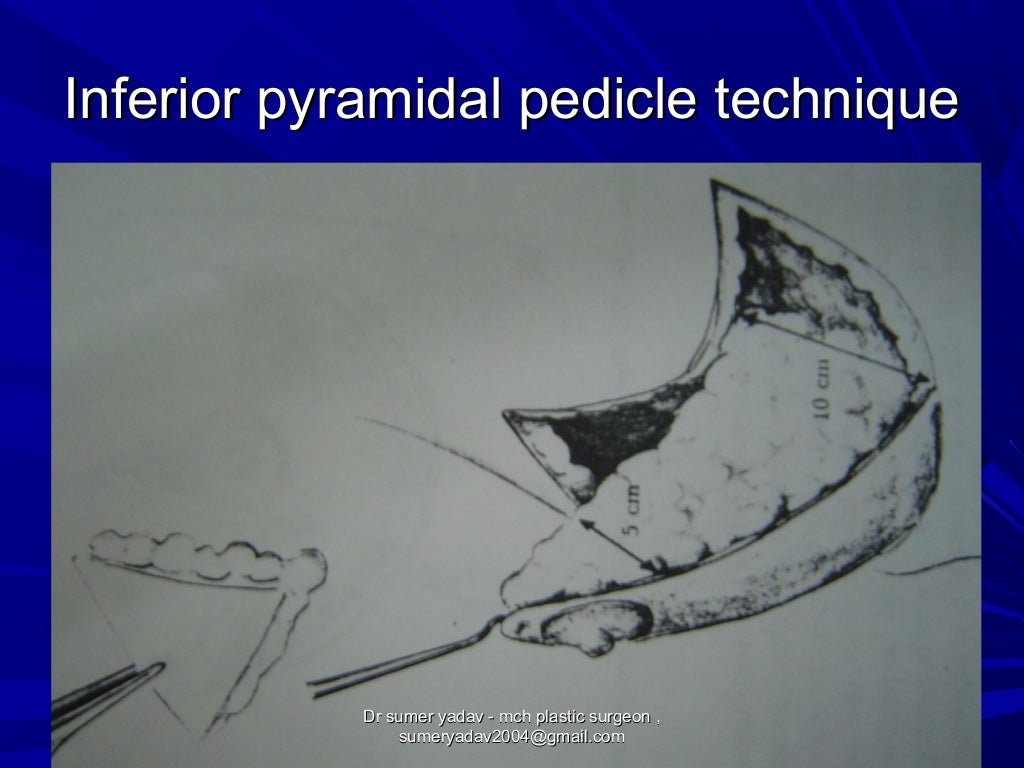 reduction mammoplasty