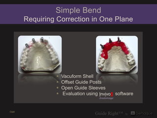 Simple Bend
       Requiring Correction in One Plane




                   Vacuform Shell
                   Offset Guide Posts
                   Open Guide Sleeves
                   Evaluation using Invivo5 software
                                     Anatomage




Oakl
 