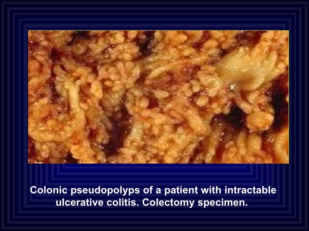 21 ulcerative colitis