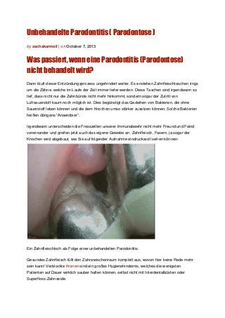 Unbehandelte Parodontitis ( Parodontose )
by sachakarmoll | on October 7, 2013
Was passiert, wenn eine Parodontitis (Parodontose)
nicht behandelt wird?
Dann läuft dieser Entzündungsprozess ungehindert weiter. Es enstehen Zahnfleischtaschen rings
um die Zähne, welche im Laufe der Zeit immer tiefer werden. Diese Taschen sind irgendwann so
tief, dass nicht nur die Zahnbürste nicht mehr hinkommt, sondern sogar der Zutritt von
Luftsauerstoff kaum noch möglich ist. Dies begünstigt das Gedeihen von Bakterien, die ohne
Sauerstoff leben können und die dem Knochen umso stärker zusetzen können. Solche Bakterien
heißen übrigens “Anaerobier”.
Irgendwann unterscheiden die Fresszellen unserer Immunabwehr nicht mehr Freund und Feind
voneinander und greifen jetzt auch das eigene Gewebe an: Zahnfleisch, Fasern, ja sogar der
Knochen wird abgebaut, wie Sie auf folgender Aufnahme eindrucksvoll sehen können:
Ein Zahnfleischloch als Folge einer unbehandelten Parodontitis.
Gesundes Zahnfleisch füllt den Zahnzwischenraum komplett aus, wovon hier keine Rede mehr
sein kann! Verblockte Kronen sind ein großes Hygienehindernis, welches die wenigsten
Patienten auf Dauer wirklich sauber halten können, selbst nicht mit Interdentalbüsten oder
Superfloss-Zahnseide.
 