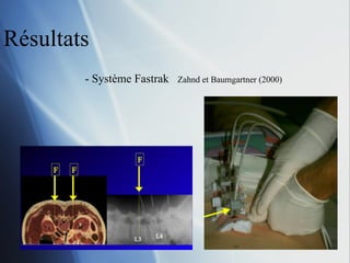 Résultats - Système Fastrak  Zahnd et Baumgartner (2000) 