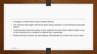 • A triangle is excised with its apex located inferiorly.
• The Johanson flap begins with the lip lesion being resected in a full-thickness rectangular
fashion.
• A full-thickness horizontal incision is then extended from the inferior defect margin in one
or both directions for a unilateral or bilateral flap, respectively.
• Partial-thickness incisions are stair-stepped inferolaterally for a total of two to four steps.
Prof Subbiah et al
 