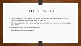 GILLIES FAN FLAP
• full-thickness flap, that moves lip and cheek tissue around the corner of the mouth to
reconstruct a lateral defect of the upper or lower lip.
• full-thickness incision that begins laterally, turns vertically and then turns back towards the
opposite lip
• The flap is rotated around the commissure.
• CON: Blunting of the commissure.
Prof Subbiah et al
 