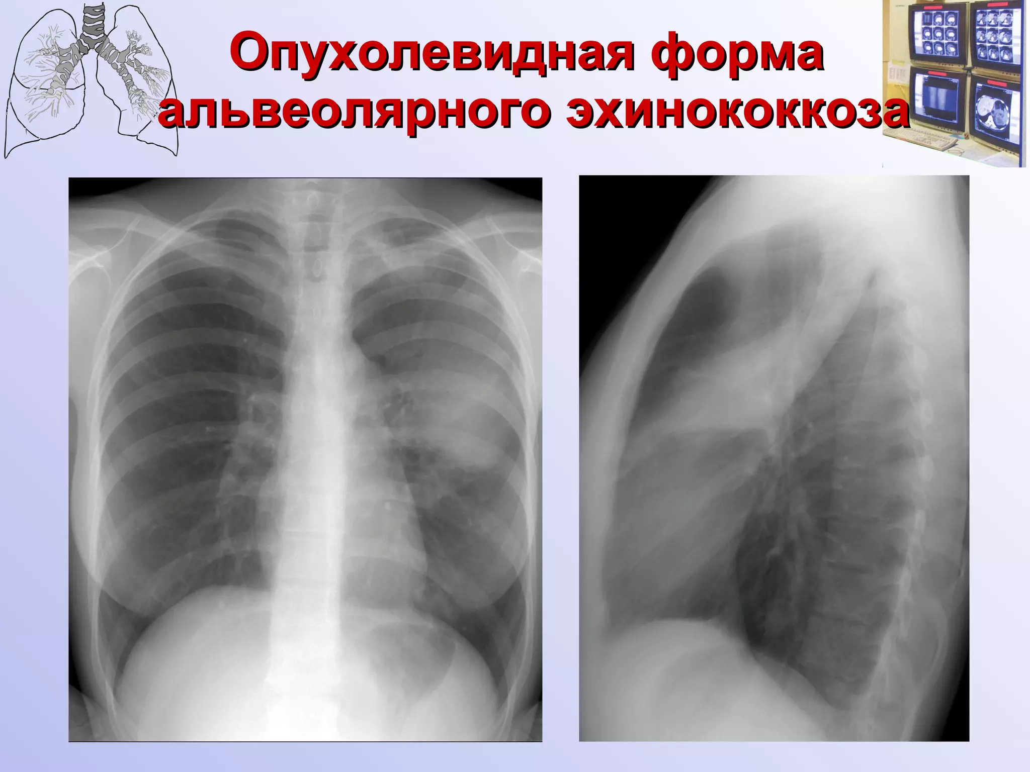 Опухолевидная форма  альвеолярного эхинококкоза 