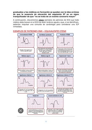 11
graduados y los médicos en formación se quedan con la idea errónea
de que la ausencia de elevación del segmento ST es un signo
tranquilizador de que "no se trata de un evento coronario mayor"
A continuación, discutiremos cinco ejemplos de patrones de ECG que todo
médico debe buscar en el ECG de dolor torácico agudo y que, si se identifican,
deberían impulsar una consulta de cardiología para considerar una ICP
inmediata.
EJEMPLOS DE PATRONES OMI – EQUIVALENTES STEMI
 