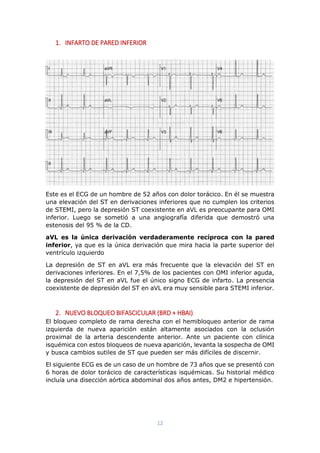 12
1. INFARTO DE PARED INFERIOR
Este es el ECG de un hombre de 52 años con dolor torácico. En él se muestra
una elevación del ST en derivaciones inferiores que no cumplen los criterios
de STEMI, pero la depresión ST coexistente en aVL es preocupante para OMI
inferior. Luego se sometió a una angiografía diferida que demostró una
estenosis del 95 % de la CD.
aVL es la única derivación verdaderamente recíproca con la pared
inferior, ya que es la única derivación que mira hacia la parte superior del
ventrículo izquierdo
La depresión de ST en aVL era más frecuente que la elevación del ST en
derivaciones inferiores. En el 7,5% de los pacientes con OMI inferior aguda,
la depresión del ST en aVL fue el único signo ECG de infarto. La presencia
coexistente de depresión del ST en aVL era muy sensible para STEMI inferior.
2. NUEVO BLOQUEO BIFASCICULAR (BRD + HBAI)
El bloqueo completo de rama derecha con el hemibloqueo anterior de rama
izquierda de nueva aparición están altamente asociados con la oclusión
proximal de la arteria descendente anterior. Ante un paciente con clínica
isquémica con estos bloqueos de nueva aparición, levanta la sospecha de OMI
y busca cambios sutiles de ST que pueden ser más difíciles de discernir.
El siguiente ECG es de un caso de un hombre de 73 años que se presentó con
6 horas de dolor torácico de características isquémicas. Su historial médico
incluía una disección aórtica abdominal dos años antes, DM2 e hipertensión.
 