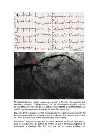 16
El ecocardiograma mostró aquinesia anterior y fracción de eyección del
ventrículo izquierdo (FEVI) global de 35%. Se realizó coronariografía urgente
que evidenció suboclusión de ADA ostial con abundante carga trombótica. Se
realizó tromboaspiración e implante de stent farmacoactivo.
El patrón EKG expuesto en estos casos representa la oclusión/suboclusión de
la arteria coronaria descendente anterior proximal y fue descrito por Winter
en 2008, aunque ya se había documentado previamente.
Las ondas T simétricas y picudas han sido descritas en el IAM hiperagudo,
pero lo característico del patrón de Winter es que el electrocardiograma no
evoluciona a elevación del ST, sino que es un patrón estático. Los
 