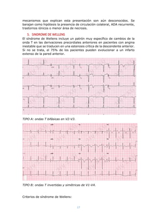 17
mecanismos que explican esta presentación son aún desconocidos. Se
barajan como hipótesis la presencia de circulación colateral, ADA recurrente,
trastornos iónicos o menor área de necrosis.
5. SINDROME DE WELLENS
El síndrome de Wellens incluye un patrón muy específico de cambios de la
onda T en las derivaciones precordiales anteriores en pacientes con angina
inestable que se traducen en una estenosis crítica de la descendente anterior.
Si no se trata, el 75% de los pacientes pueden evolucionar a un infarto
extenso de la pared anterior.
TIPO A: ondas T bifásicas en V2-V3.
TIPO B: ondas T invertidas y simétricas de V1-V4.
Criterios de síndrome de Wellens:
 