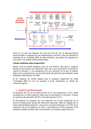 19
Como en el caso del bloqueo de rama del haz de His, la despolarización
anormal debe ir seguida de una repolarización anormal. Esto se extiende al
contexto de un complejo QRS de baja amplitud, que debe ser seguido por
una onda T de voltaje relativamente bajo.
¿Cómo medimos esta proporción?
Bueno, aquí es donde podemos caer en una brecha. Hay poca o ninguna
literatura que brinde una definición clara de lo que constituye un HATW en
cuanto al tamaño, y nos quedamos con una situación en la que el médico
debe usar su experiencia y el reconocimiento de patrones para detectar estos
hallazgos relacionados con OMI.
El Dr. Stephen W. Smith sugiere que si cualquier proporción de onda
T:complejo QRS en V1-4 es superior a 0,36, representa un infarto de
miocardio agudo.
7. INFARTO POSTERIOR AISLADO
El descenso del ST en las derivaciones V1-4, sin progresión a V5-6, debe
considerarse un OMI posterior hasta que se demuestre lo contrario, incluso
en ausencia de elevación del ST en las derivaciones V7-9.
El IM posterior es causado por una reducción en el flujo sanguíneo en la
porción infraauricular dorsal del ventrículo izquierdo. Esta es irrigada por la
arteria descendente posterior, rama de la coronaria derecha en el 70% de la
población, de la circunfleja en el 10%, o de ambas en el 20% restante. El IM
posterior aislado se debe más comúnmente a la oclusión aguda del LCx.
 