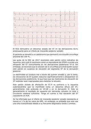20
El ECG demuestra un descenso aislado del ST en las derivaciones V2-4,
preocupante para un infarto de miocardio posterior aislado.
El paciente se sometió a un cateterismo que demostró una oclusión circunfleja
proximal del 100 % .
Las guías de la ESC de 2017 reconocen este patrón como indicativo de
isquemia, pero solo lo reconocen como un equivalente de STEMI si existe una
elevación del ST concomitante en las derivaciones posteriores V7-9. Sin
embargo, se reconoce que la oclusión de la circunfleja proximal puede causar
este patrón en ausencia de elevación del segmento ST de la derivación
posterior.
La electricidad se conduce mal a través del pulmón aireado y, por lo tanto,
las elevaciones de ST pueden reducirse significativamente o desaparecer en
las derivaciones posteriores, lo que hace que las mediciones de elevación de
ST estándar sean inapropiadas para detectar la oclusión.
Este patrón aislado de afectación de V1-4 es contrario a la isquemia
subendocárdica que se manifiesta como un descenso difuso del ST,
generalmente más profundo en V4-V6 y en la derivación II. Esto es
generalmente el resultado de isquemia por demanda, oclusión no total o
circulación colateral suficiente. Tenga en cuenta si hay elevación del ST
coexistente en AvR.
Se ha informado que el infarto de miocardio posterior aislado representa al
menos el 3 % de los casos de OMI; sin embargo, es probable que esta sea
una cifra subnotificada debido a su frecuente diagnóstico tardío u omitido.
 