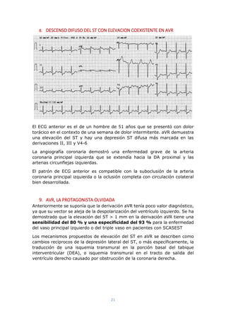 21
8. DESCENSO DIFUSO DEL ST CON ELEVACION COEXISTENTE EN AVR
El ECG anterior es el de un hombre de 51 años que se presentó con dolor
torácico en el contexto de una semana de dolor intermitente. aVR demuestra
una elevación del ST y hay una depresión ST difusa más marcada en las
derivaciones II, III y V4-6
La angiografía coronaria demostró una enfermedad grave de la arteria
coronaria principal izquierda que se extendía hacia la DA proximal y las
arterias circunflejas izquierdas.
El patrón de ECG anterior es compatible con la suboclusión de la arteria
coronaria principal izquierda o la oclusión completa con circulación colateral
bien desarrollada.
9. AVR, LA PROTAGONISTA OLVIDADA
Anteriormente se suponía que la derivación aVR tenía poco valor diagnóstico,
ya que su vector se aleja de la despolarización del ventrículo izquierdo. Se ha
demostrado que la elevación del ST > 1 mm en la derivación aVR tiene una
sensibilidad del 80 % y una especificidad del 93 % para la enfermedad
del vaso principal izquierdo o del triple vaso en pacientes con SCASEST
Los mecanismos propuestos de elevación del ST en aVR se describen como
cambios recíprocos de la depresión lateral del ST, o más específicamente, la
traducción de una isquemia transmural en la porción basal del tabique
interventricular (DEA), o isquemia transmural en el tracto de salida del
ventrículo derecho causado por obstrucción de la coronaria derecha.
 