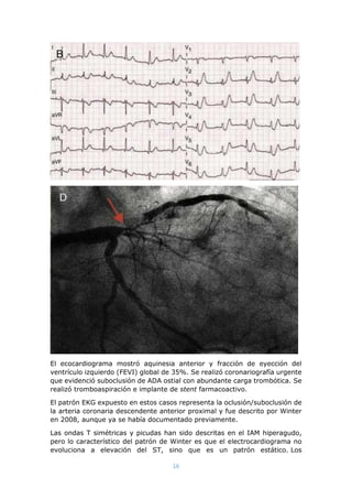 16
El ecocardiograma mostró aquinesia anterior y fracción de eyección del
ventrículo izquierdo (FEVI) global de 35%. Se re...