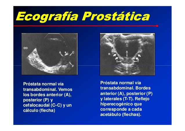 22. ecografia prostatica 22. ecografia prostatica