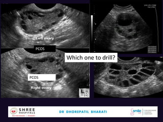 Ovarian Drilling Do's & Don'ts - By Dhorepatil Bharati | PPTX