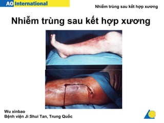Nhiễm trùng sau kết hợp xương
Nhiễm trùng sau kết hợp xương
Wu xinbao
Bệnh viện Ji Shui Tan, Trung Quốc
 