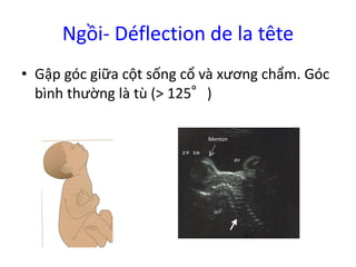 Ngồi- Déflection de la tête
• Gập góc giữa cột sống cổ và xương chẩm. Góc
bình thường là tù (> 125°)
Menton
 