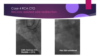 Cto Dual Injection Abdul Mozid: New developments in wire based antegrade approach | PDF