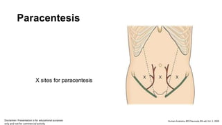 Paracentesis
X sites for paracentesis
 