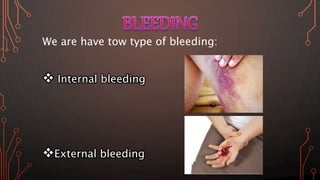 We are have tow type of bleeding:
 Internal bleeding
External bleeding
 