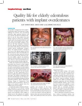 implantology section

Quality life for elderly edentulous
patients with implant overdentures
AJAY VIKRAM SINGH, SUNITA SINGH & ALEJANDRO VIVAS ROJO
INTRODUCTION
The prosthetic management of the completely edentulous patient has long been a major
challenge for dentistry. The conventional
edentulous ridge supported dentures, well
over centuries, has been the traditional standard of care for these patients but most
patients could not achieve the satisfactory
comfort with the conventional dentures and
suffer with several problems such as inadequate retention and stability, inability to chew
and eat, soft tissue abrasions, continuous
bone loss, phonetics problem, longer adaptation period, teeth setting in the neutral zone
causing altered maxillofacial relations.
Hence, the implant-retained overdentures
can be one of the ultimate options for these
patients because it offers several benefits over
the conventional ridge supported dentures
such as improved function, improved retention and stability, reduced size prosthesis,
improved chewing efficiency, decreased soft
tissue abrasion, improved maxillofacial prosthesis, and prevention of further ridge loss.
While most implant-based treatment has
historically been focused on fixed implant
supported prosthesis, the implant overdenture offers several benefits over fixed implant
prosthesis to the edentulous patients in terms
of improved function, physical health, and
esthetics, lower treatment cost, less invasive
procedures (no bone augmentation procedures are usually required), easy maintenance
and repair. The implant overdentures have
only fewer disadvantages over the fixed prosthesis such as psychological feeling of bearing
removable prosthesis, regular maintenance,
relining, change of components, food
impaction under the prosthesis, and loss of
ridge in the posterior segment where the
implants have not been placed.
A step by step proper evaluation and treatment planning for the patients seeking
implant retained prosthesis has been shown
to result in an improved quality of life for
patients and predictable results leading to
clinical success. The indication for implant
prosthesis may be limited due to inadequate

FIG 1: Facial Appearance of the patient during his first
appointment

FIG 2: Clinical evaluation showing multiple missing
teeth and periodontitis, generalized attrition, and
abfractions in the remaining teeth

FIG 3: Preoperative radiograph showing need for
extraction and replacement of all teeth

FIG 4: Case planned using CT planning software to
place adequately long implants

FIG 5: Teeth are extracted and implants are immediately placed into the extraction sockets

quantity and structure of the bone.
Enhancement of esthetic appearance and
facial morphology through replacement of
lost hard and soft tissues may be proven easier, if not more effective, with removable overdentures than with conventional fixed prosthesis, with possibly decreased costs and less

22 Dental Practice // May-June 2013 // Vol 11 No 6

surgical intervention.
When the patient seeking a full mouth
prosthesis enters the clinic so many factors
“which are very important” should be evaluated before reaching a decision for that particular prosthesis. These factors include age of
the patient, medical problems, physical
health, his or her ability to undergo grafting
procedures, ridge form, soft tissue situation,
maxilla-mandibular relation, cause of teeth
loss, bone density and availability to insert
implants, number of implants required to
provide fixed or removable prosthesis,
patient’s expectations from the final prosthesis, patient’s ability to maintain the prosthesis, and cost affordability to the patient.
There is abundance of literatures presenting a variety of treatment options, case
reports, and clinical techniques over the past

 