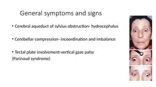 General symptoms and signs
• Cerebral aqueduct of sylvius obstruction- hydrocephalus
• Cerebellar compression- incoordination and imbalance
• Tectal plate involvement-vertical gaze palsy
(Parinaud syndrome)
 