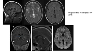 Image courtesy of radiopedia rID:
2646
 