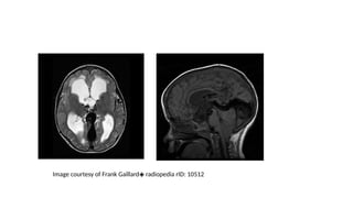 Image courtesy of Frank Gaillard radiopedia rID: 10512
◈
 