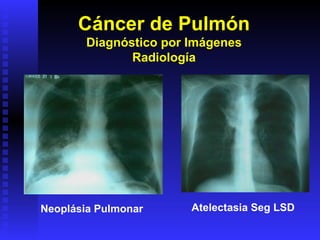 Cáncer de Pulmón Diagnóstico por Imágenes Radiología Neoplásia Pulmonar Atelectasia Seg LSD 