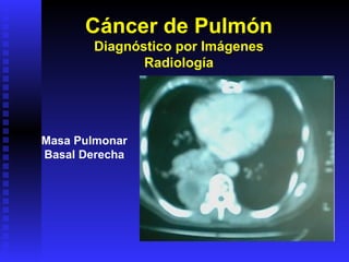 Cáncer de Pulmón Diagnóstico por Imágenes Radiología Masa Pulmonar Basal Derecha 