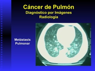 Cáncer de Pulmón Diagnóstico por Imágenes Radiología Metástasis Pulmonar 