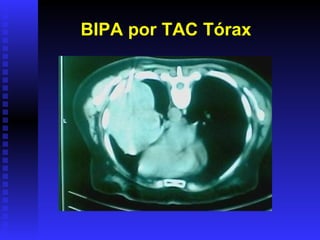 BIPA por TAC Tórax 