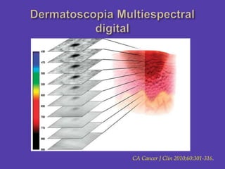 DermatoscopiaMultiespectral digital<br />CA Cancer J Clin 2010;60:301-316.<br />