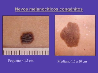 Nevos melanocíticos congénitos<br />Pequeño < 1,5 cm<br />Mediano 1,5 a 20 cm<br />