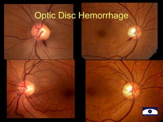 Optic Disc Hemorrhage
 