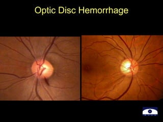 Optic Disc Hemorrhage
 