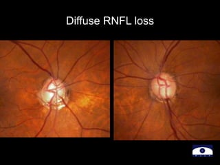 Diffuse RNFL loss
 